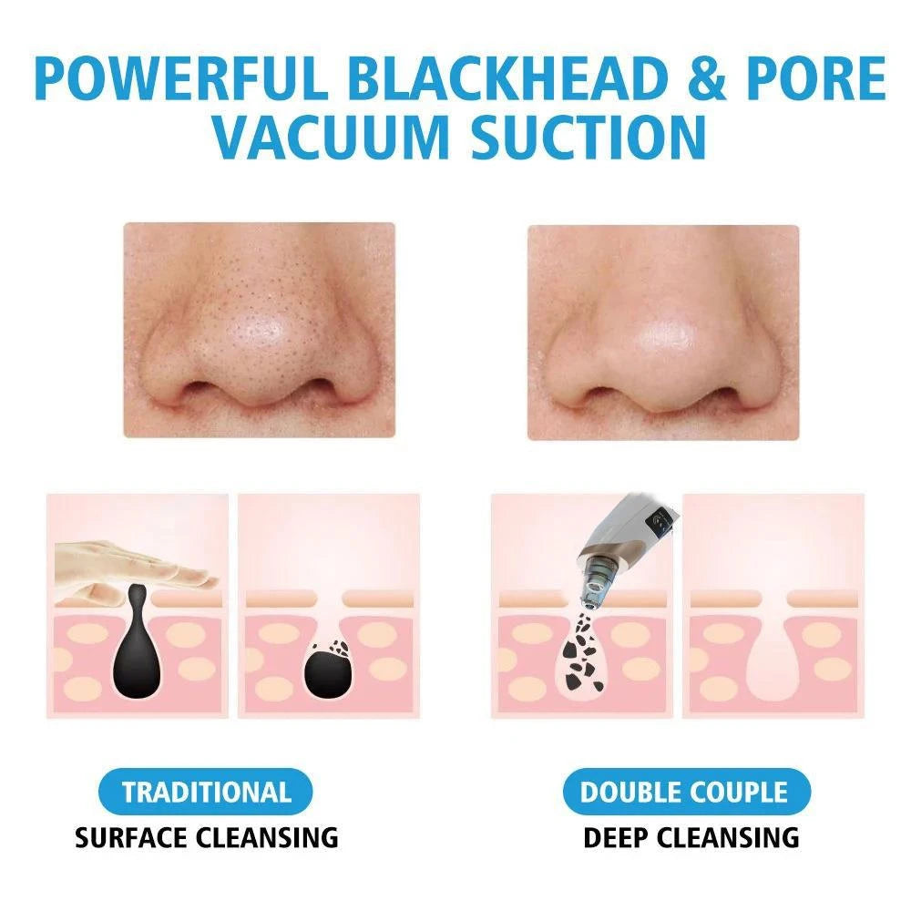XB Blackhead Remover